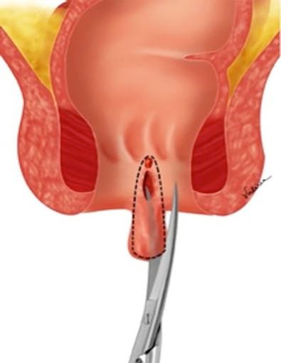 anal